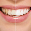 Teeth Cleaning And Bleaching